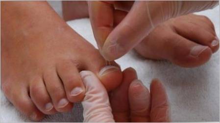 Nokti na nogama odrastu: uzroci i metode liječenja