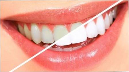 Kako izbjeljivati ​​zube kod kuće?